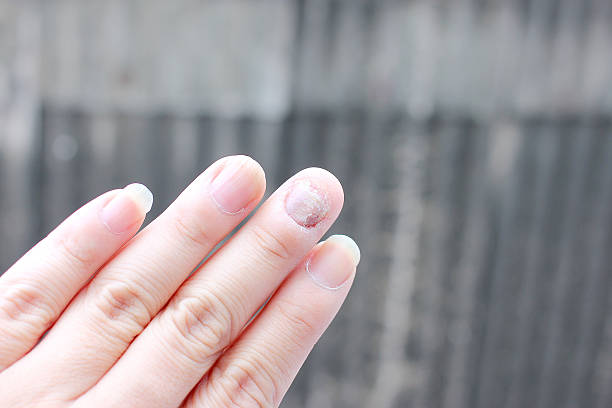 Stop peeling nails with these tips: protect cuticles, avoid harsh chemicals, moisturize regularly, and use a strengthening treatment. - Nail care tips to prevent peeling and breakage.