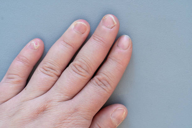 Discover the vitamin deficiency behind peeling nails - Get expert advice